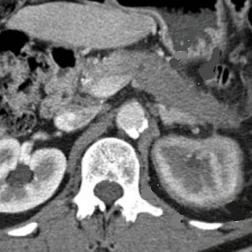 IgG4 Related Disease